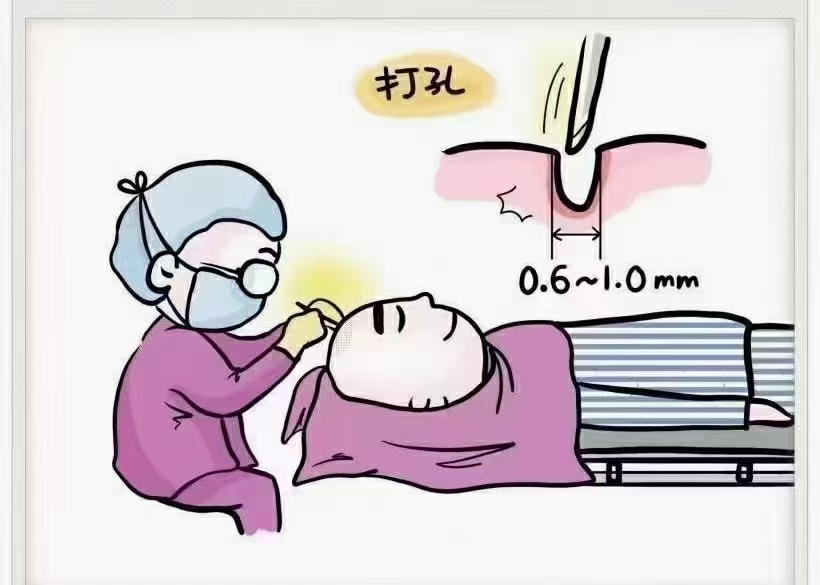 大家谈谈植发的经历,植发真的是一个漫长的过程