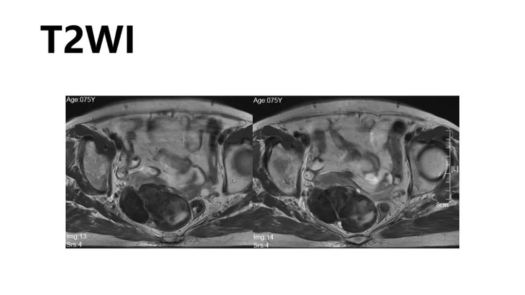 卵巢原发肿瘤的分析思路