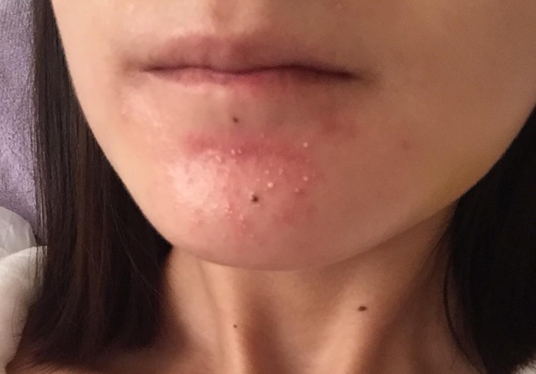 下巴周围反复长白头粉刺什么原因,下巴上的闭口白头粉刺怎么去除