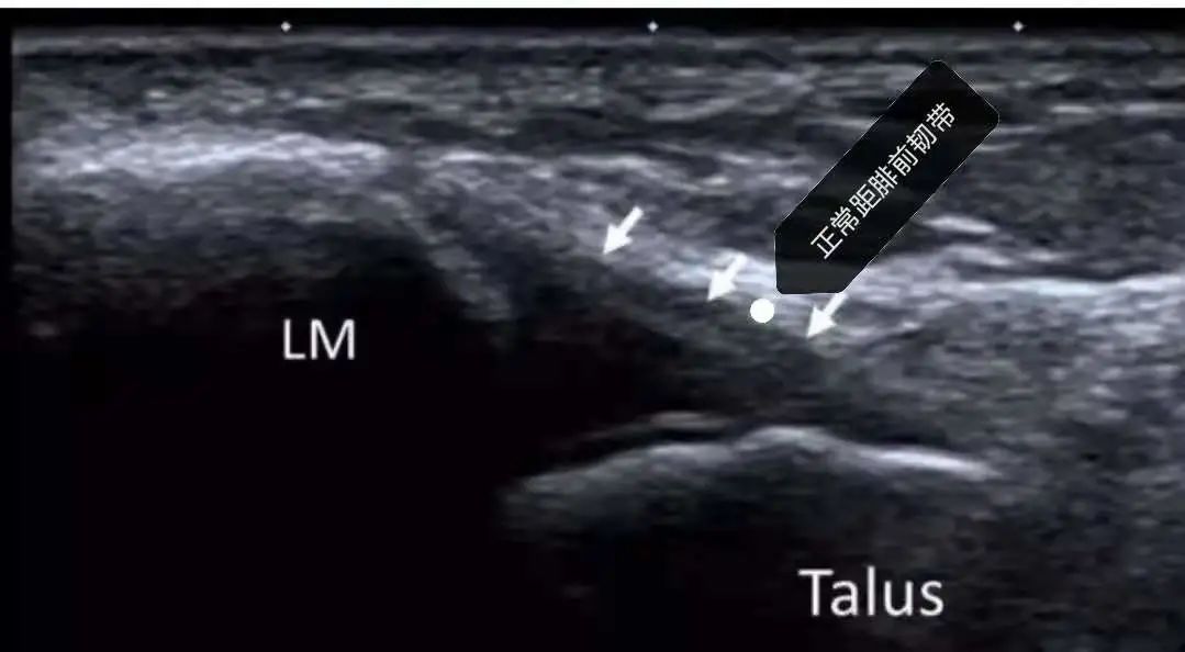 手麻肌电图检查过程视频,手麻脚麻肌电图正常