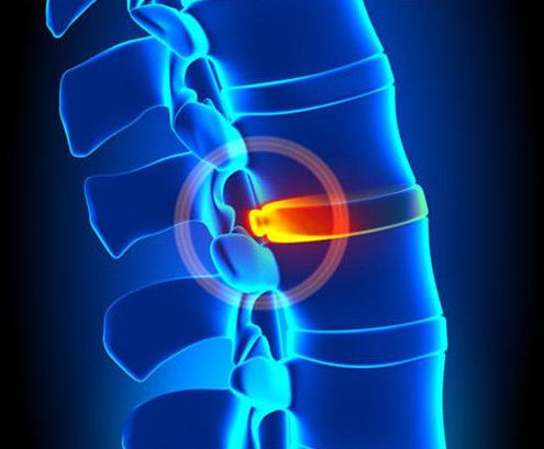 铁腰板治腰突效果怎样,腰突治疗仪铁腰板多少钱