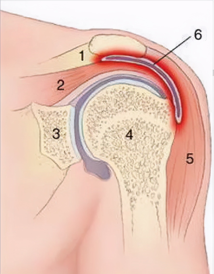 滑囊炎跟滑膜炎的区别是什么,滑囊炎和滑膜炎怎样区别