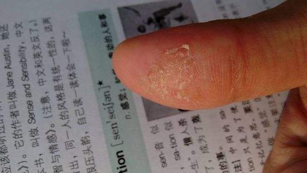 手脚起小水泡特别痒怎么根治,手脚生水泡奇痒什么原因