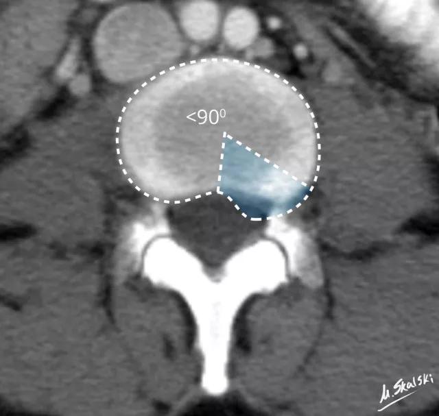 椎间盘膨出影像学表现,椎间盘脱出和突出鉴别影像学表现