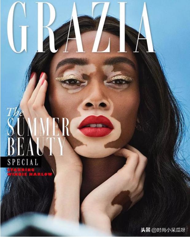 患白癜风的超模,有白癜风的国际名模