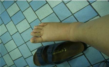 消除孕晚期水肿最快方法,孕中晚期水肿是怎么回事