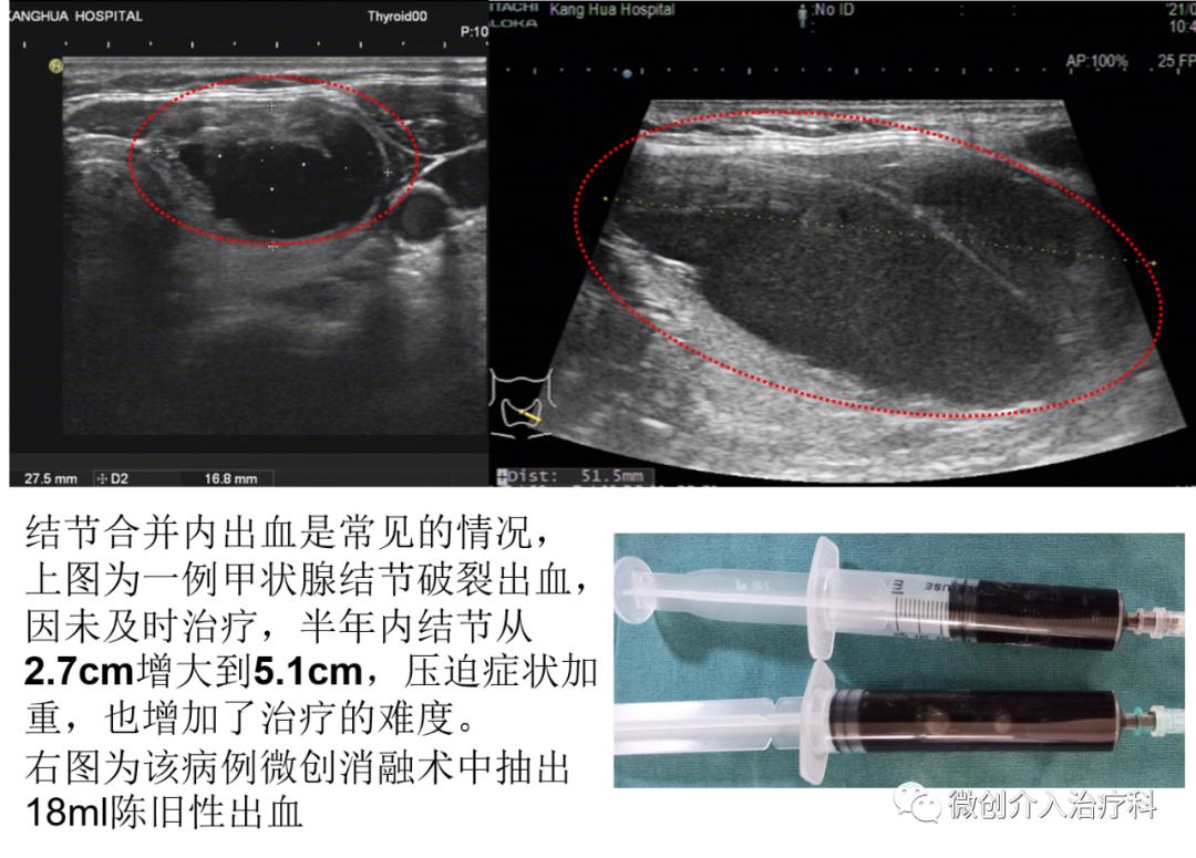 甲状腺结节微创消融手术,甲状腺结节微创消融医保