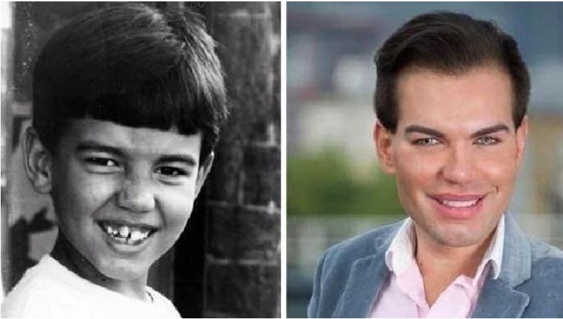 “真人肯尼”痴迷整容多年后，最终将自己整成了女人