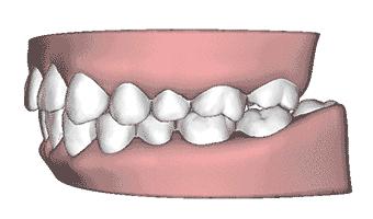 牙齿矫正之七大误区,牙齿矫正这14个副作用你信了几个