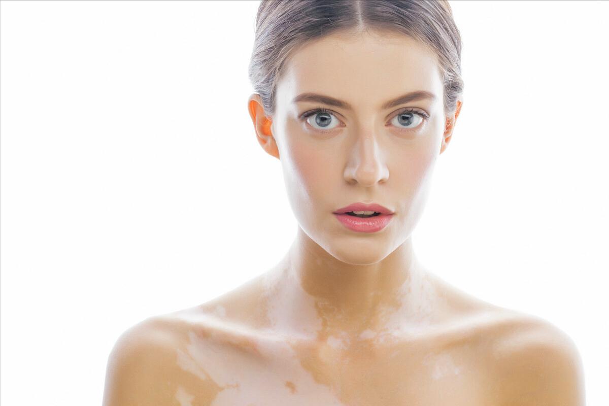 身上出现白斑是癌症吗,身上出现白斑都是白癜风吗