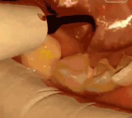 牙齿多久不刷会形成牙垢,牙齿背面没刷可以吗