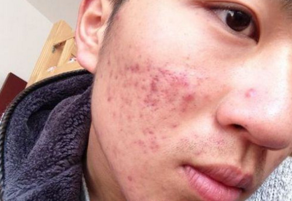 怎么有效祛除痘印痘坑小妙招,脸上有痘印痘坑怎么消除小妙招