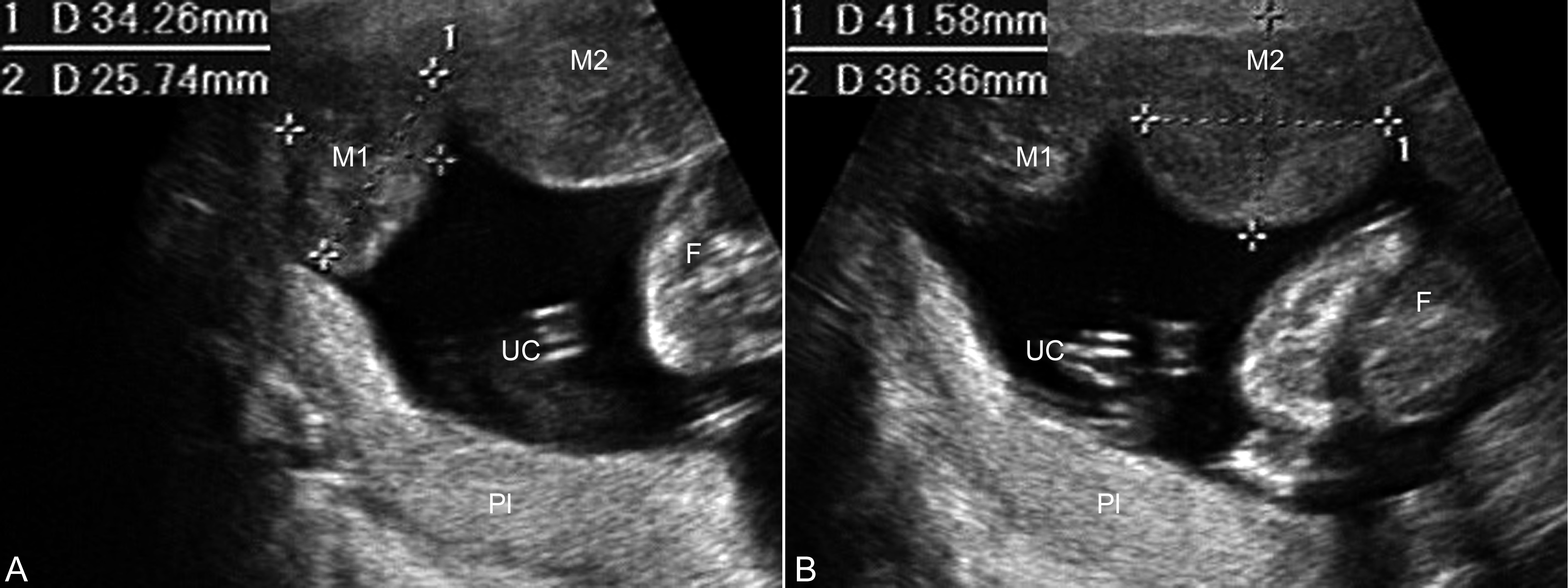 明明白白做超声33-1：妊娠合并子宫肿瘤
