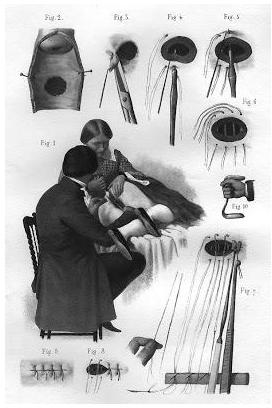 惊叹“鸭嘴形窥器”的前世今生