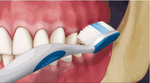 改变刷牙方式楔状缺损就会停止吗,刷牙导致楔状缺损牙齿会断么