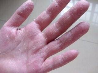 手秋冬脱皮脱得很严重怎么办,一到秋天手就脱皮怎么办