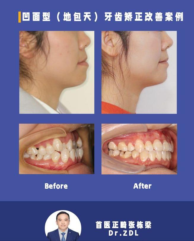 戴牙套矫正牙齿脸型会变好看吗,隐形牙套矫正后脸型变化