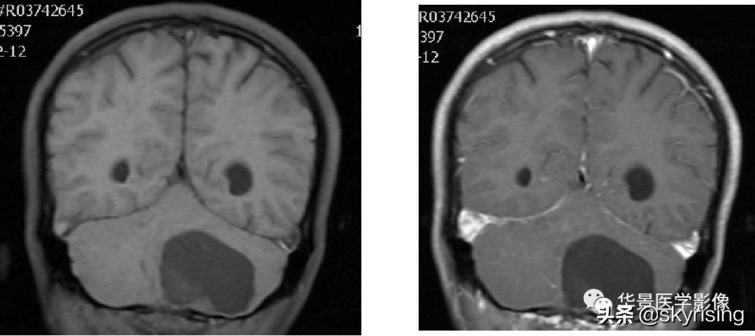 椎体侵袭性血管瘤mri影像学表现,中年妇女脑部血管海绵体瘤的症状