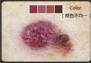 脸上长痣越来越多怎么回事,想把脸上的痣去掉去医院哪个科