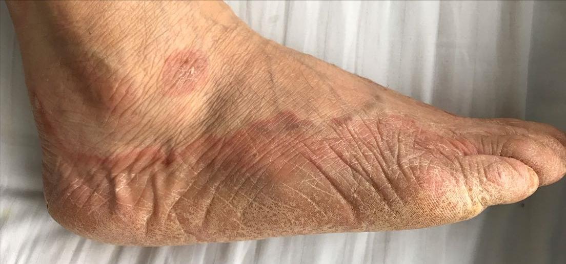 手脚湿疹和癣的区别,手足癣干裂脱皮怎么治