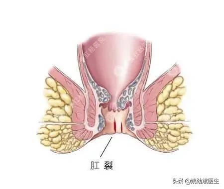 肛裂吃什么能根除,治疗宝宝肛裂的小方法有哪些