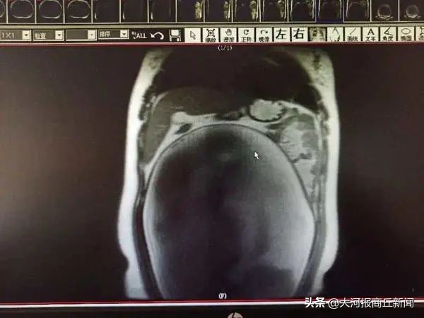 25岁女孩肚子巨型肿瘤,肚子里特大肿瘤的25岁女孩