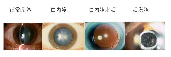 白内障术后都会发生后发障吗,白内障术后都会后发障吗