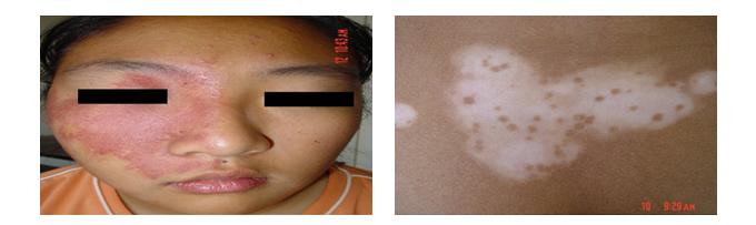 皮肤病蛇缠腰是什么症状,手部常见皮肤病的症状及治疗