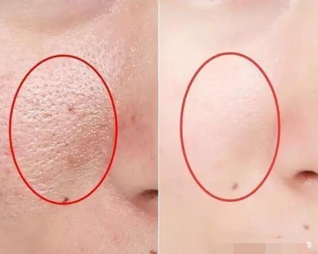 19岁姑娘打溶脂针,女子打美容针脸肿