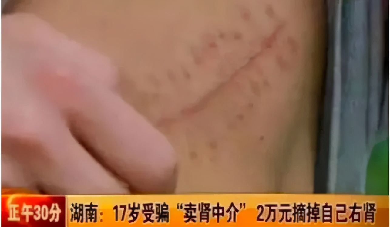 当年换苹果手机卖肾的男孩现状,10年前卖肾换苹果手机的小伙