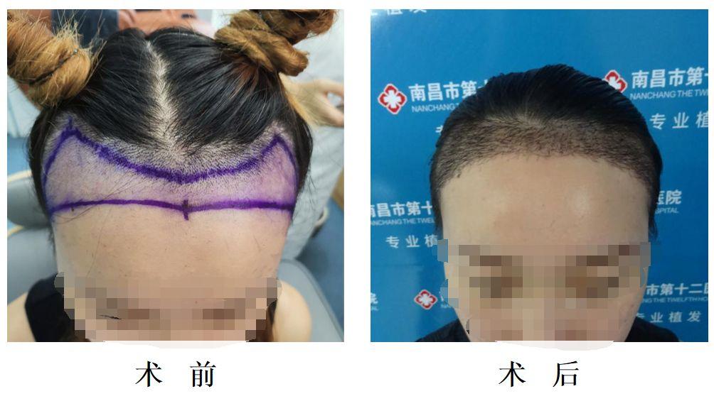 头发种植是怎么操作的,头发种植利弊有哪些呢