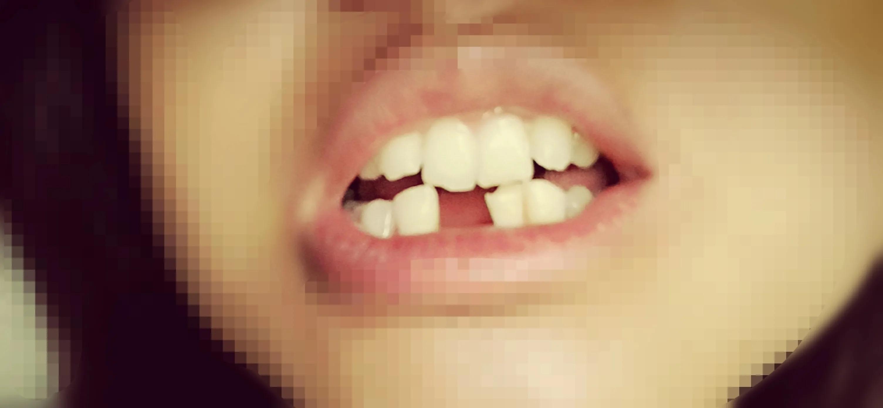 我的种植牙亲身经历,我的种牙经历感受