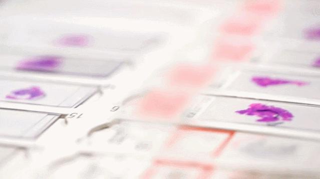 病理报告为什么这么慢,手术后病理报告准确率高吗