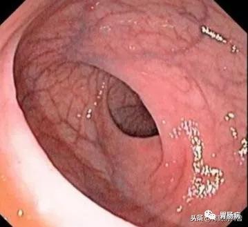 给大家科普胃肠镜,胃肠镜科普讲座