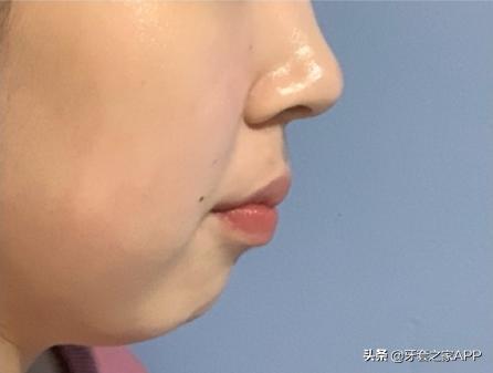不靠整容怎么改变下巴后缩？看这里