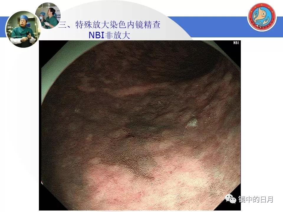 低分化胃癌早期时候做内镜手术吗,早期胃癌内镜手术后追加外科手术