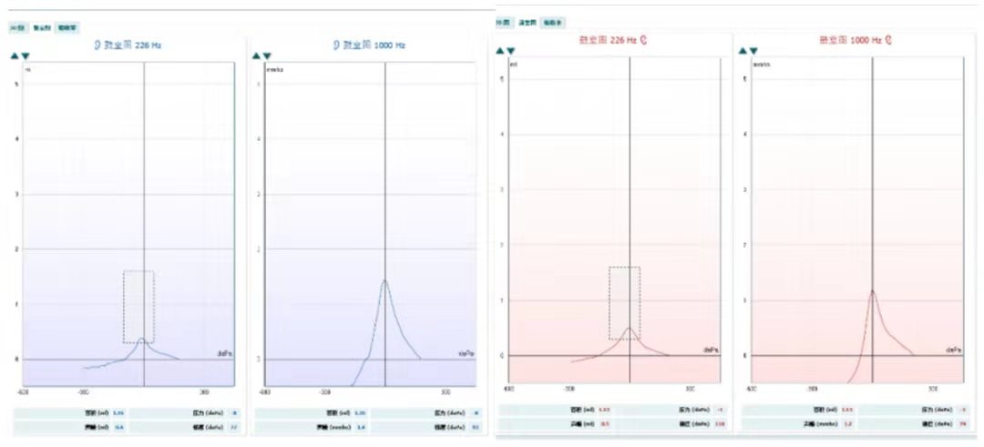 助听器惠耳听力,惠耳助听器中度耳聋