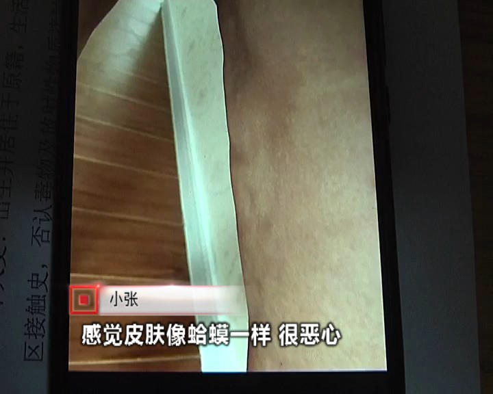 女子抽脂术后皮肤坏死,抽脂后身上掉皮