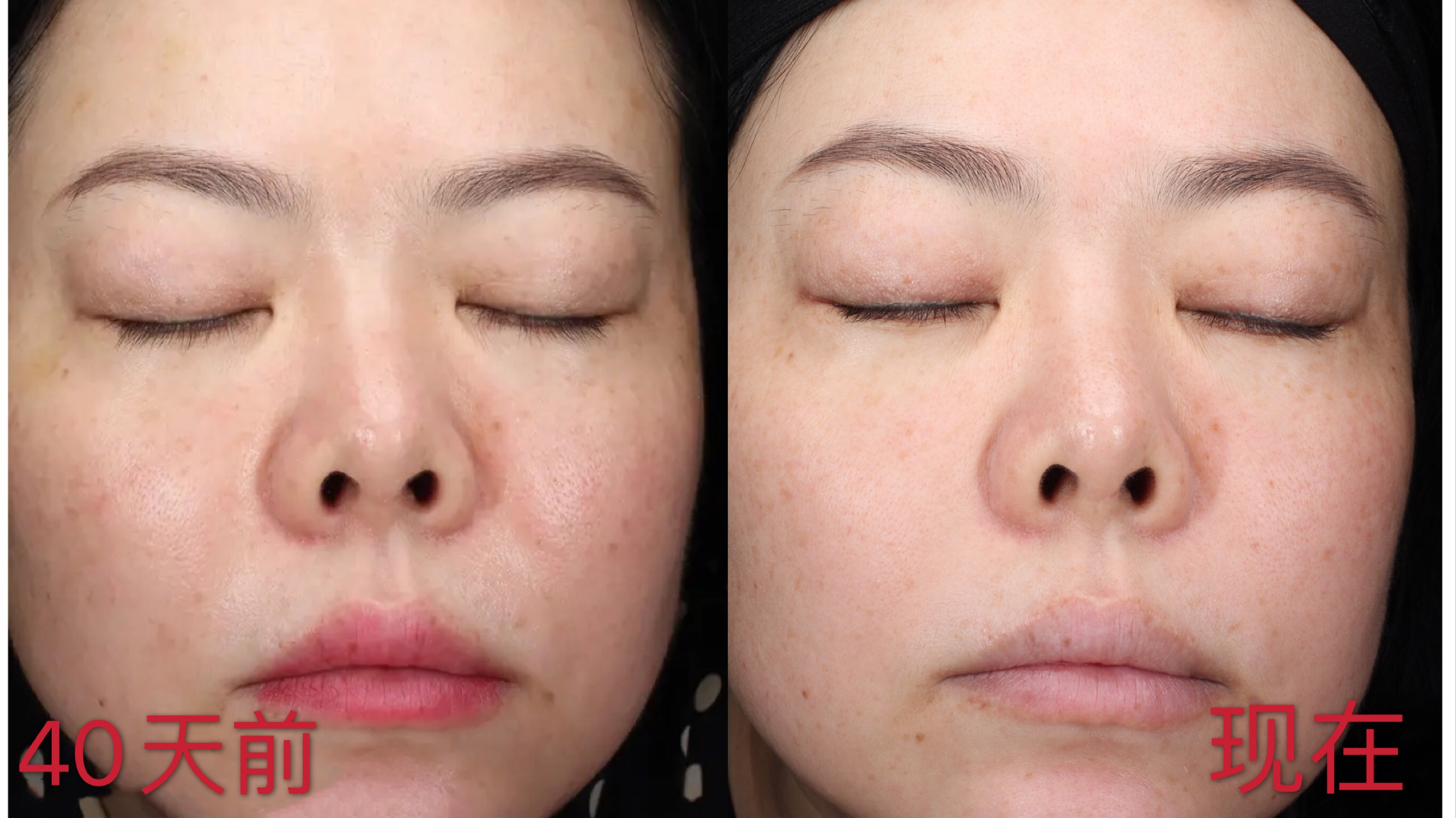 玉兰油大红瓶和skii大红瓶测评,玉兰油淡斑小白瓶和sk2小灯泡比较