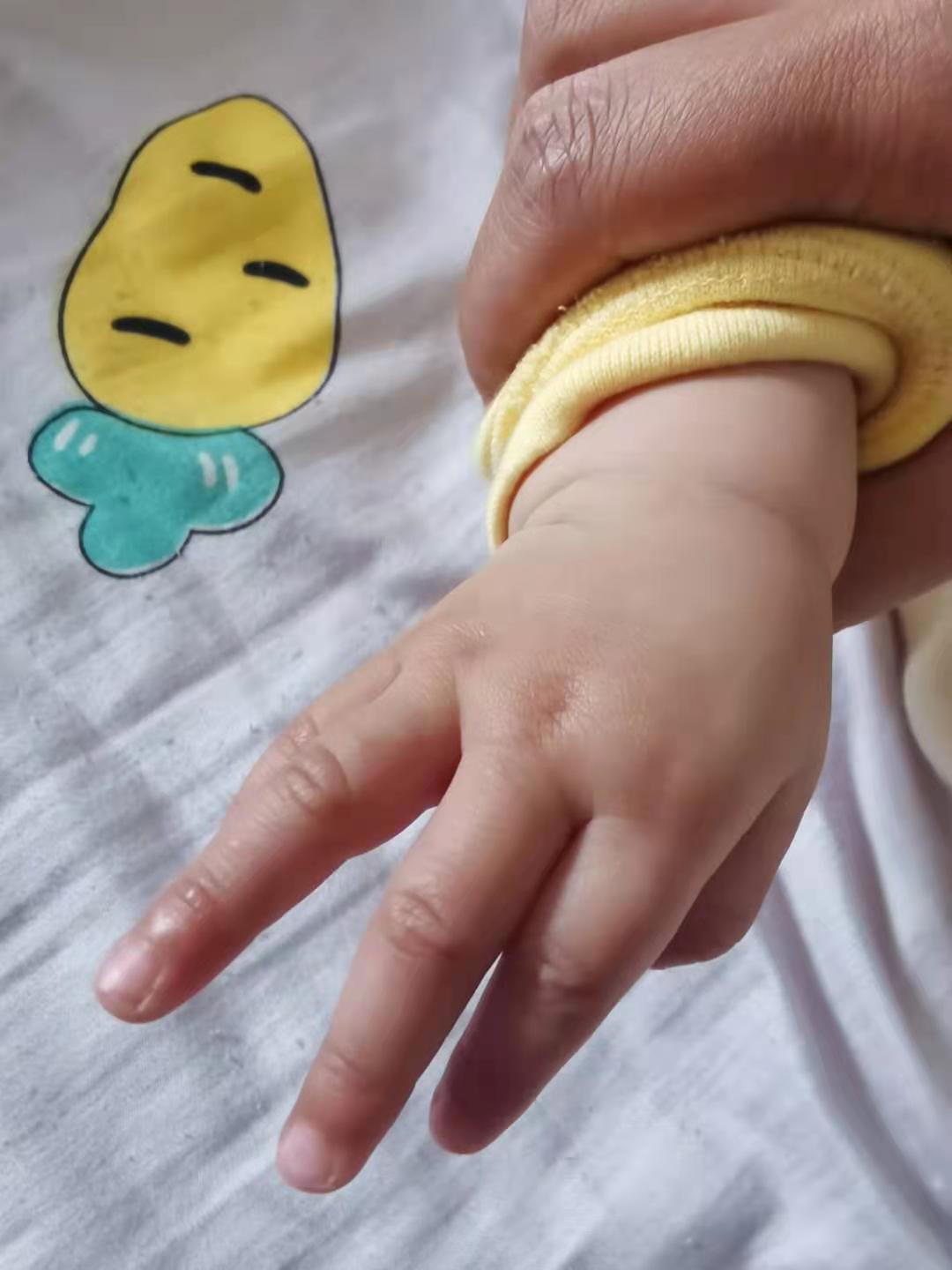 五个月宝宝手红肿了怎么回事,5个月宝宝手突然红肿是怎么回事