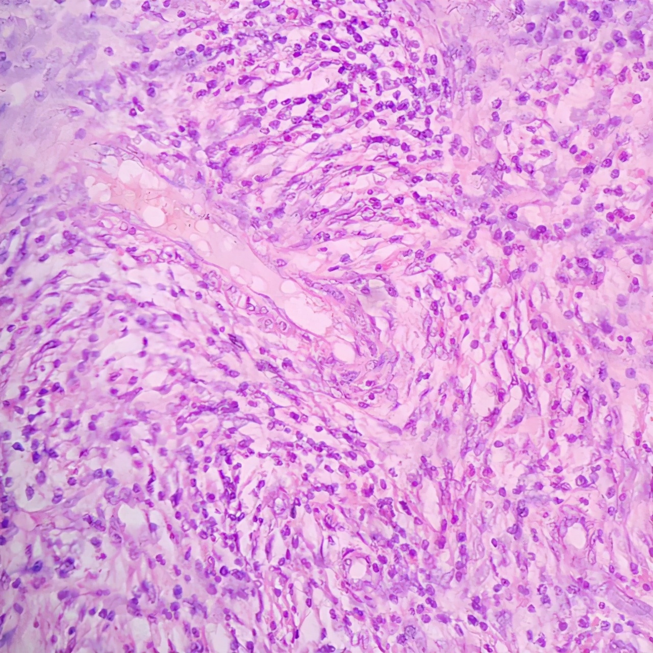 所有的肠癌都是由肠息肉演变的吗,所有肠癌都是肠息肉发展来的吗