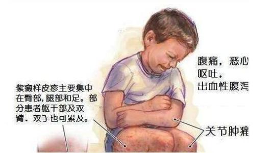 过敏性紫癜儿童的治疗方法及用药,儿童过敏性紫癜复查需要复查血吗