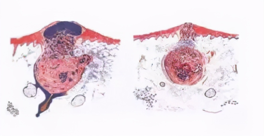 黑头粉刺毛孔粗大怎么隐形毛孔,毛孔粗大cc霜怎么用才能隐形毛孔