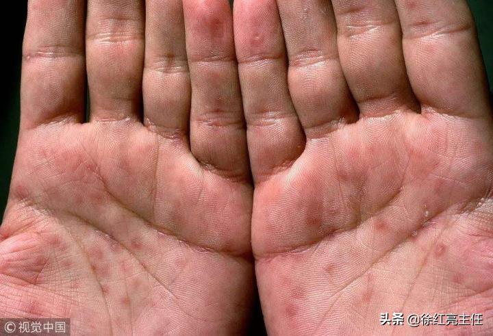 【皮肤科那点事】接触梅毒患者,医生怕不怕被感染?