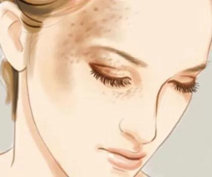 如何区分脸上色斑类型图片,如何辨别面部的各种斑