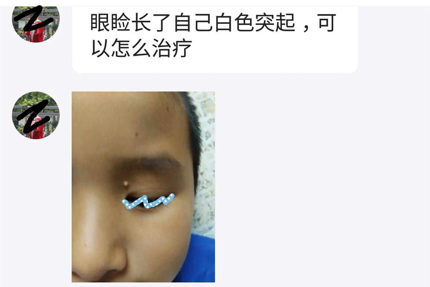 一岁孩子眼皮有几个疹子,小孩上眼皮长的像癣一样的东西