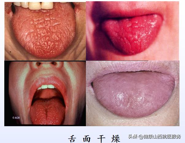 牙齿变黑是哪种疾病的前兆,牙齿全黑腐烂是什么引起的