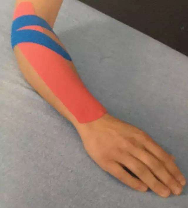 网球肘一定是打网球造成的吗,打网球如何防止网球肘