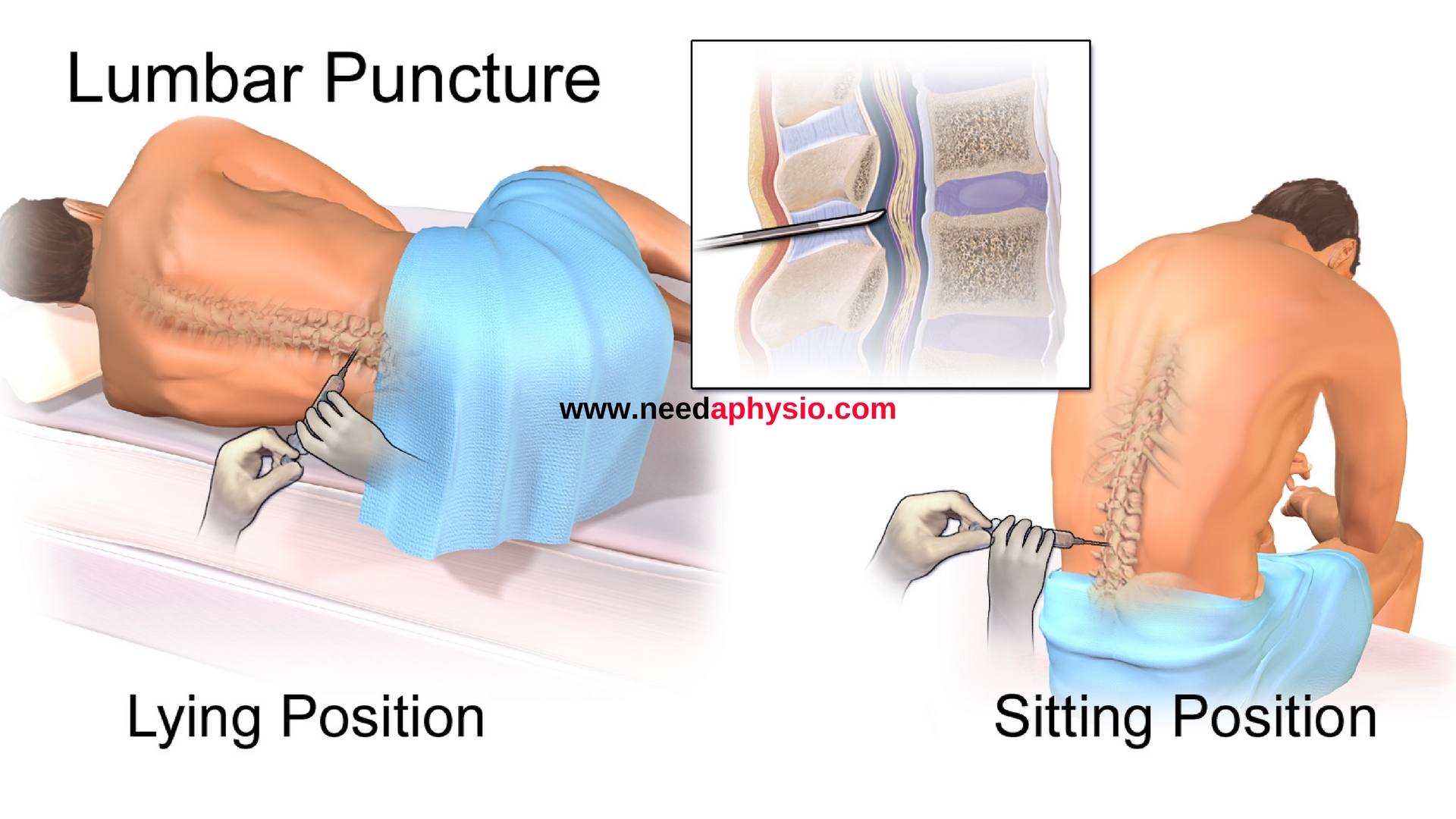 他发明阴道窥器、治疗产后漏尿，实验是17岁女孩无麻醉手术30次