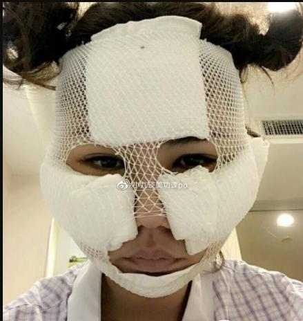 哪个明星做了颧骨内推,颧骨内推明星前后对比